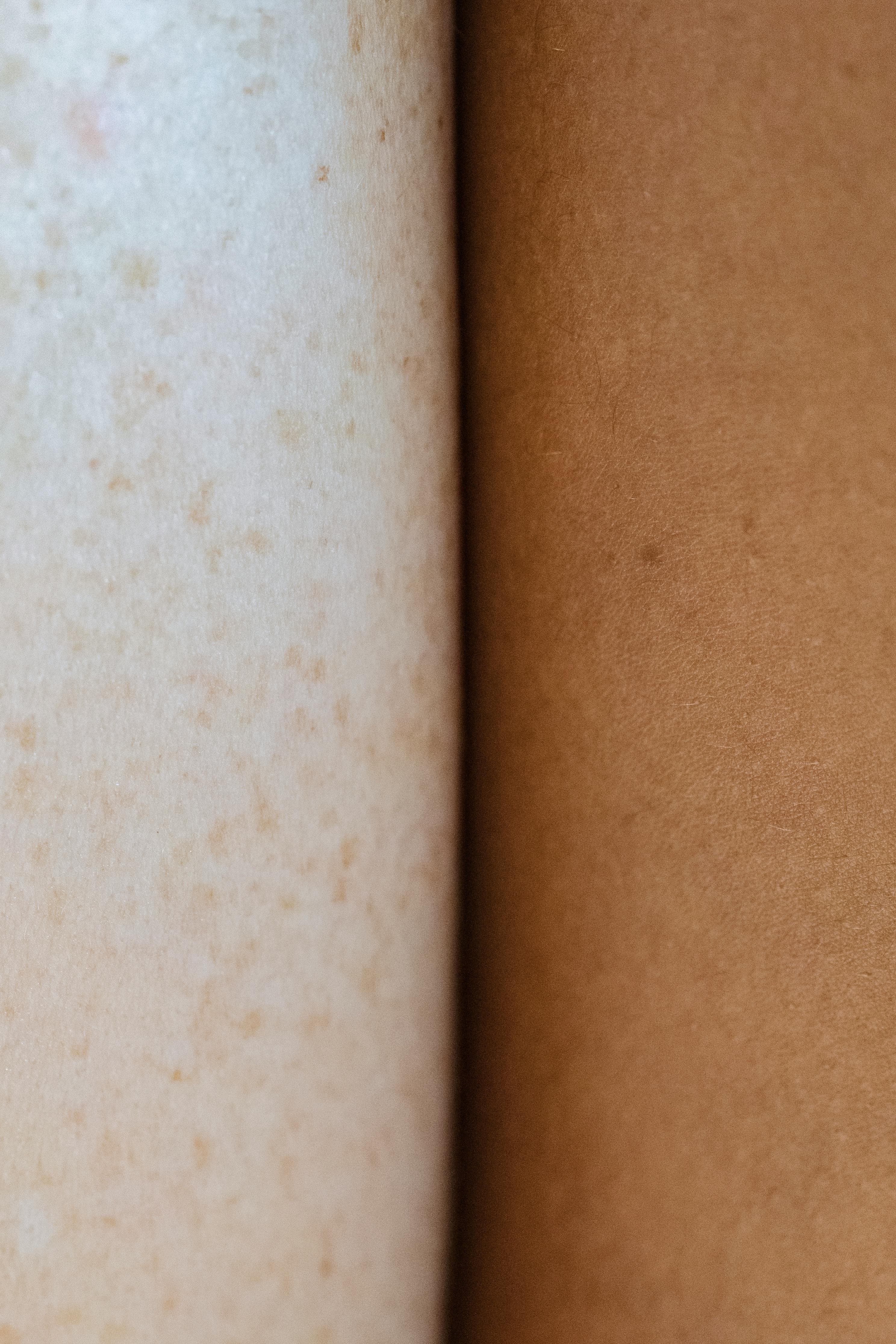 Comparison chart of skin symptoms in different conditions